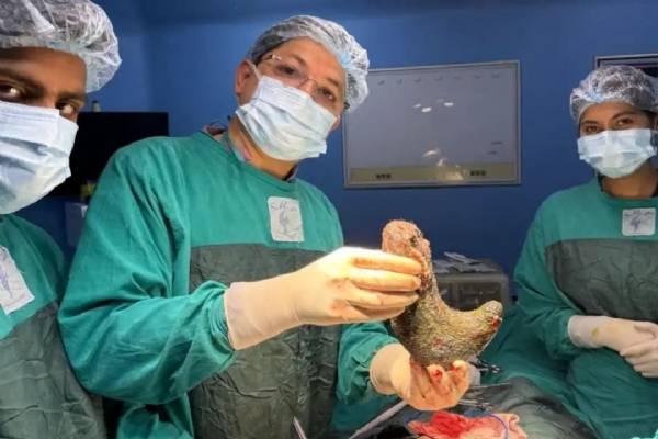 آپریشن کے دوران خاتون کے پیٹ سے نکلا ڈیڑھ کلو بالوں کا گچھا