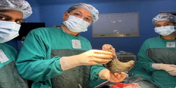 آپریشن کے دوران خاتون کے پیٹ سے نکلا ڈیڑھ کلو بالوں کا گچھا