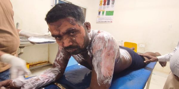 سسرال بلا کر نوجوان کو زندہ جلانے کی کوشش