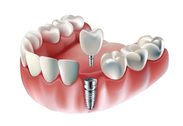 DENTAL-IMPALNT-EASY-NOW-